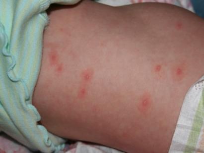 Вирус Коксаки у ребенка: симптомы, виды и лечение