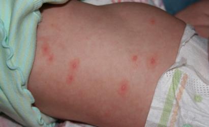 Вірус Коксакі у дитини: симптоми, види та лікування